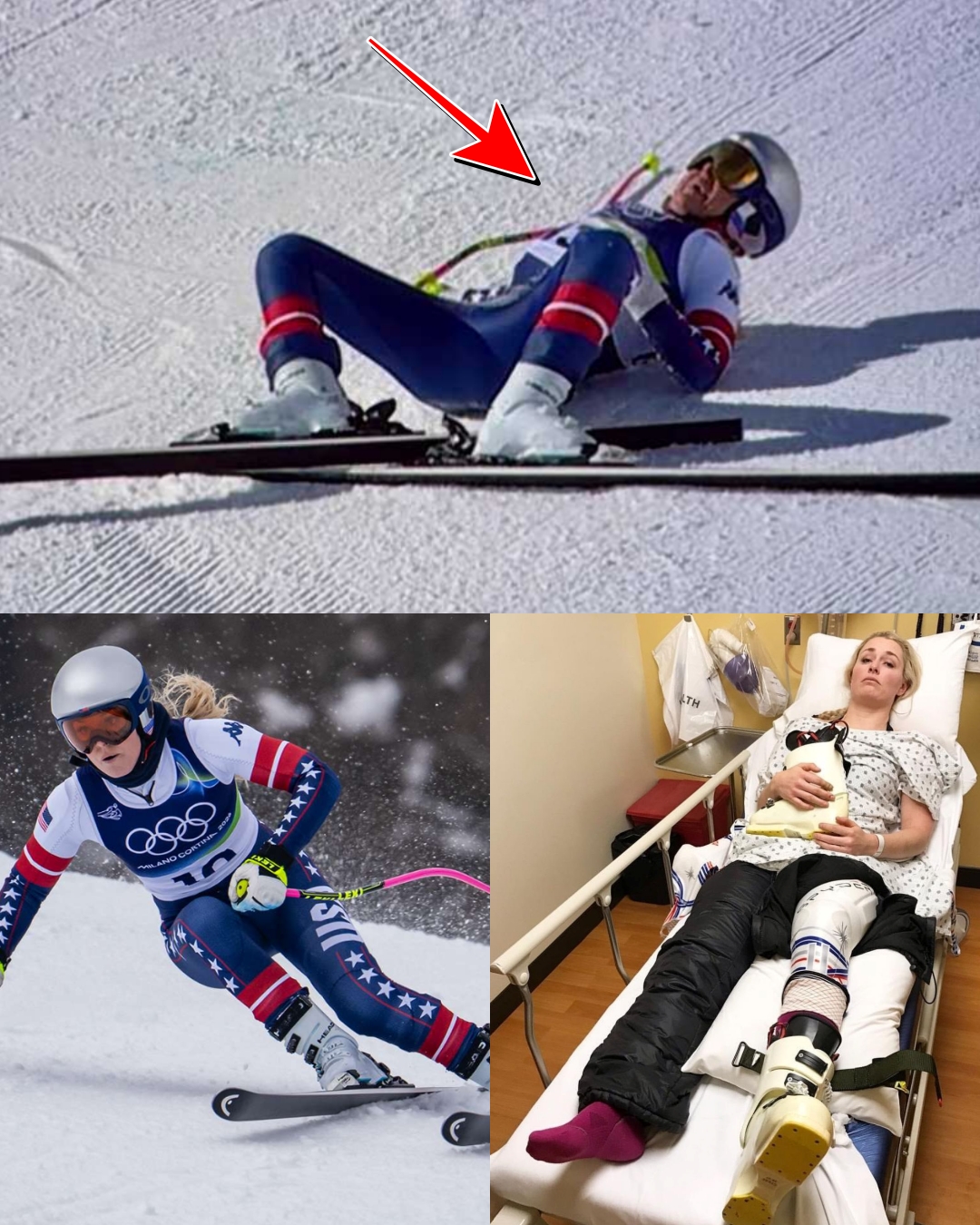 With the 2026 Winter Olympics drawing closer, Lindsey Vonn has confirmed she will undergo multiple surgeries after a devastating crash.