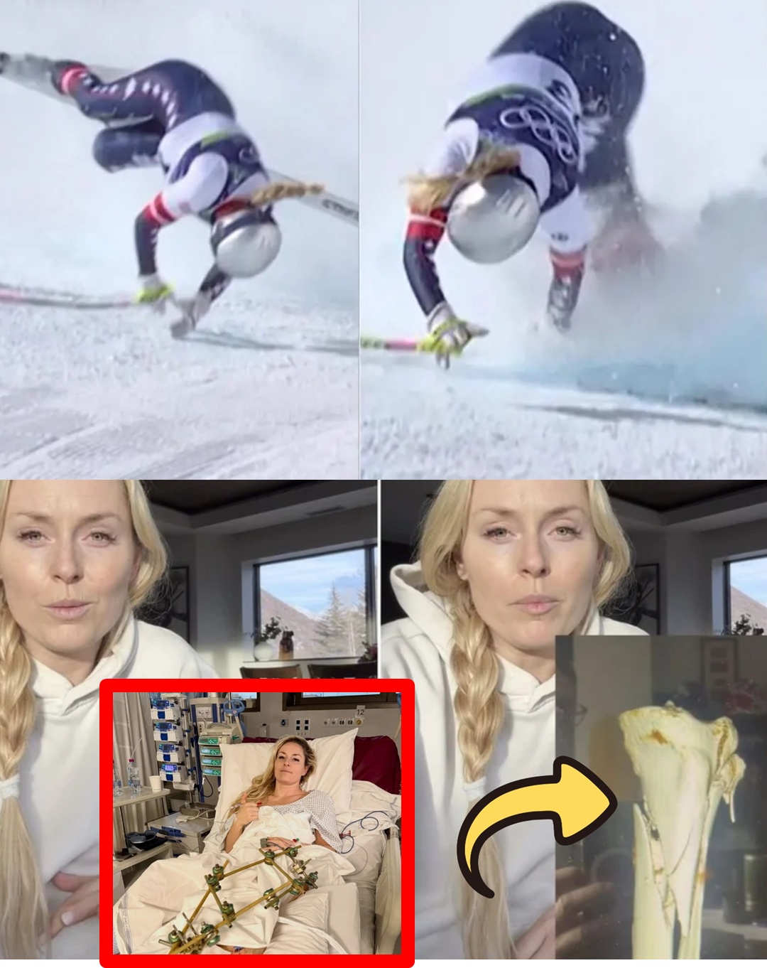 To save his legs, Vonn had to undergo a series of complex surgeries, and his condition is now..