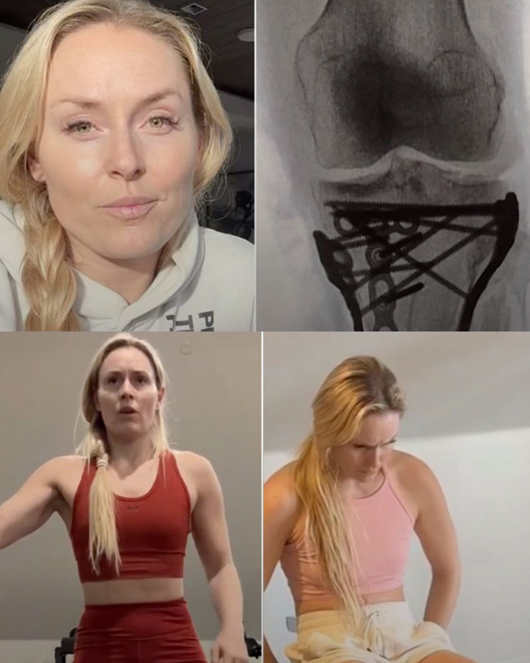 Lindsey Vonn is on the road to recovery after her devastating crash at the 2026 Winter Olympics